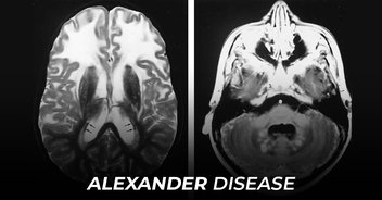 Alexander disease is a progressive neurological disease of cerebral white matter.-img