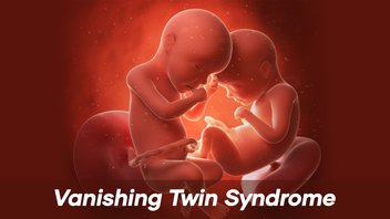 Vanishing Twin Syndrome (Human Chimerism)-img